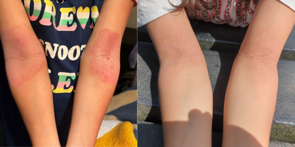 Eczema & Atopic Dermatitis Cured / Fixed