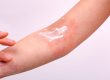 Eczema Myths and Facts
