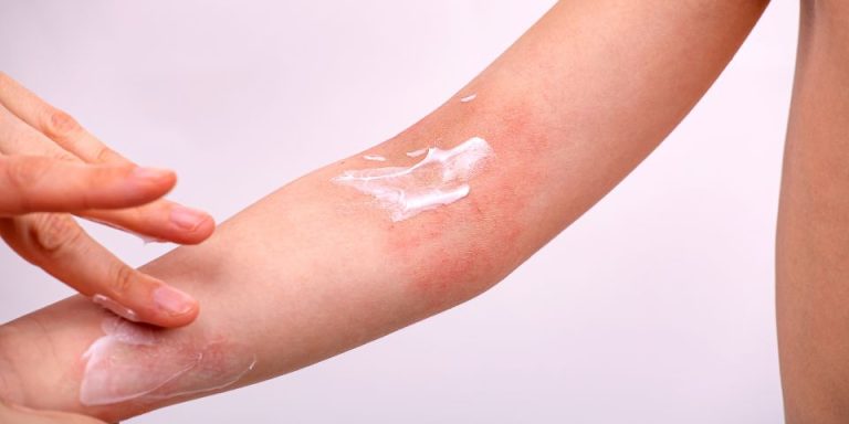 Eczema Myths and Facts