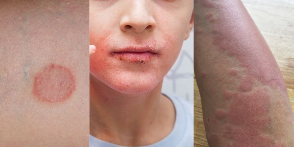 eczema and other skin stuff