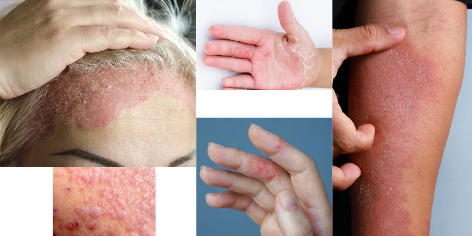 8 types of eczema