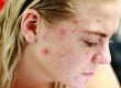 Acne Treatment - Treating Acne with Homeopathy