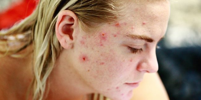 Acne Treatment - Treating Acne with Homeopathy