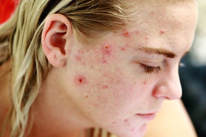 Acne Treatment – Treating Acne with Homeopathy Acne Treatment - Treating Acne with Homeopathy