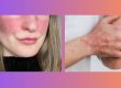 lady's face on right hand side with red marking on her cheeks. elbow and hand with psoriasis on left hand side