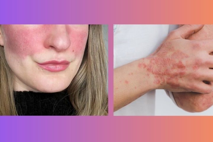 lady's face on right hand side with red marking on her cheeks. elbow and hand with psoriasis on left hand side