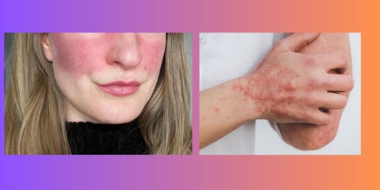 lady's face on right hand side with red marking on her cheeks. elbow and hand with psoriasis on left hand side