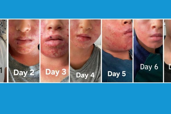 12 days impetigo gone