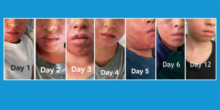 12 days impetigo gone