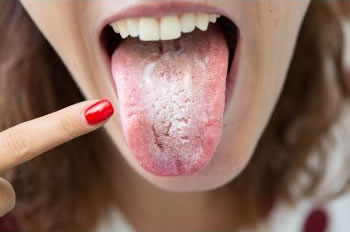 Thrush and Fungal Infections