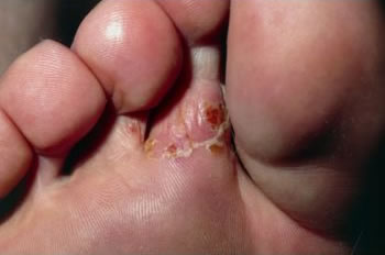 Thrush and Fungal Infections