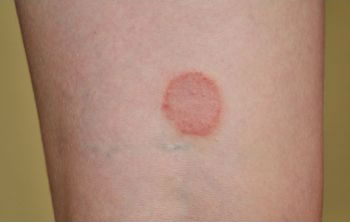 Ringworm - Thrush and Fungal Infections