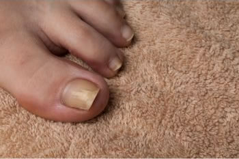 Fungal Nail Infection - Thrush and Fungal Infections