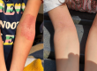 2 sets of images of arms before and after eczema cleared