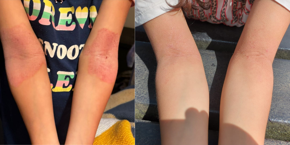 2 sets of images of arms before and after eczema cleared