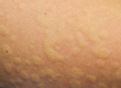 hives on skin