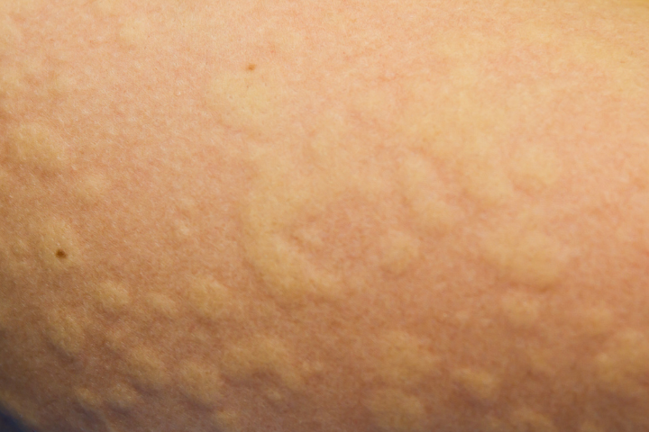 hives on skin