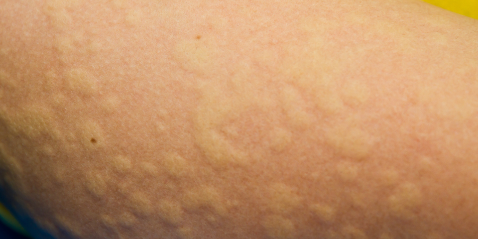urticaria hives on skin