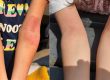 Eczema & Atopic Dermatitis Case Study - Cured / Fixed